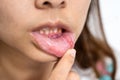 Asian woman have Aphthous ulcer or Canker sore on mouth at lip