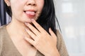 Asian woman have sore in the mouth, tongue, Aphthous Ulcer Royalty Free Stock Photo