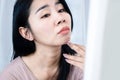 Asian woman having skin face problem with acne and scars on chin Royalty Free Stock Photo