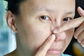 Asian woman try to squeeze nose acne pimples