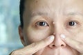 Asian woman try to squeeze nose acne pimples