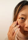 Asian Woman With Under Eye Bag. Puffy Eye Of Girl Showing Eyes Bags. Royalty Free Stock Photo