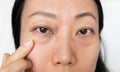 Asian Woman With Under Eye Bag. Puffy Eye Of Girl Showing Eyes Bags. Royalty Free Stock Photo