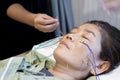 Asian woman undergoing of acupuncture beauty face treatment by electric needle therapy