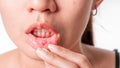 Asian women have aphthous ulcers on mouth on white background, selective focus Royalty Free Stock Photo