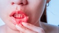 Asian women have aphthous ulcers on mouth on white background, selective focus Royalty Free Stock Photo