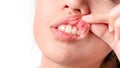 Asian women have aphthous ulcers on mouth on white background, selective focus