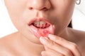 Asian women have aphthous ulcers on mouth on white background, selective focus Royalty Free Stock Photo