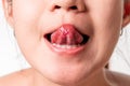 Asian women have aphthous ulcers on tongue on white background, selective focus