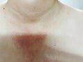 Asian women have a rash on the skin caused by dust allergies