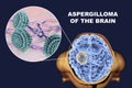 Aspergilloma of the brain and close-up view of fungi Aspergillus