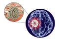 Aspergilloma of the brain and close-up view of fungi Aspergillus