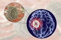 Aspergilloma of the brain and close-up view of fungi Aspergillus