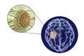 Aspergilloma of the brain and close-up view of fungi Aspergillus