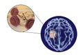 Aspergilloma of the brain and close-up view of fungi Aspergillus