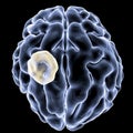 Aspergilloma of the brain