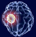 Aspergilloma of the brain