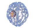 Aspergilloma of the brain