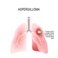 Aspergilloma. Lungs of human with a fungus ball