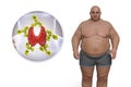 Autoimmune thyroiditis in obesity, conceptual 3D illustration showing an overweight patient and thyroid gland attacked