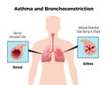 Asthma Medical Poster Royalty Free Stock Photo