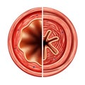 Asthma Bronchial Tube Royalty Free Stock Photo