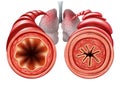 Asthma Diagram Medical Concept