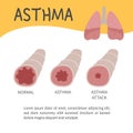 Asthma infographic