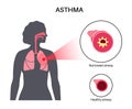 Asthma lung disease