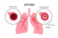 Asthma lung disease