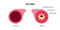 Asthma lung disease