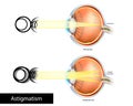 Astigmatic Eye and Normal Eye. Astigmatism, refractive or refraction error. Multiple Focal point. Royalty Free Stock Photo