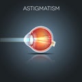 Astigmatism, blurred vission