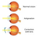 Astigmatism corrected by a cylindrical lens. Royalty Free Stock Photo