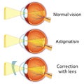 Astigmatism corrected by a cylindrical lens. Royalty Free Stock Photo