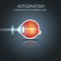 Astigmatism corrected by a cylindrical lens Royalty Free Stock Photo