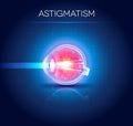 Astigmatism eyesight disorder Royalty Free Stock Photo