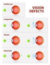 Astigmatism, Myopia and Hyperopia