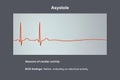 ECG in asystole, 3D illustration