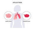 Atelectasis medical poster