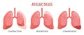 Atelectasis, a lung disease. Contraction, resorption, compression. Medical infographic banner, illustration