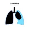 Atelectasis medical poster