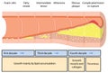 Atheroma formation Royalty Free Stock Photo