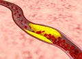 Atherosclerosis