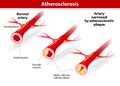 atherosclerosis