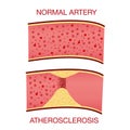 Atherosclerosis.The accumulation of cholesterol in the blood vessels