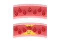 Atherosclerosis anime icon vector / fat stuck in the blood artery cholesterol