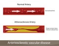 Atherosclerosis artery