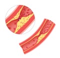 Atherosclerosis in artery