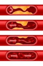 Atherosclerosis artery. Step-by-step cholesterol deposition arterial walls. Blood vessel section set. Erythrocytes flow